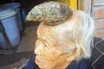 Xôn xao cụ bà 87 tuổi mọc sừng trên đầu dài 13 cm