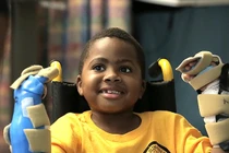 Vẻ đáng yêu tuyệt vời của em bé vừa ghép cả 2 tay