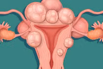 Tưởng bầu 7 tháng, cô gái khổ tâm vì thứ kẹt cứng trong bụng