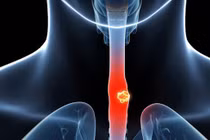 Ăn ngủ kiểu này, sớm muộn cơ thể cũng mắc ung thư thực quản