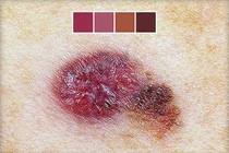 Xem vị trí, hình dạng nốt ruồi phát hiện ung thư da nguy hiểm