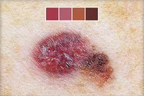 Xem vị trí, hình dạng nốt ruồi phát hiện ung thư da nguy hiểm