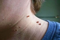 Giật mình mối nguy sức khỏe từ mụn thịt dư trên cổ