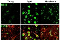 Bảo vệ não ngừa bệnh Alzheimer