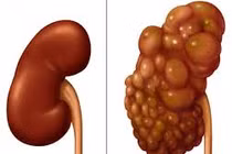 Mắc bệnh bẩm sinh, bé trai chào đời với quả thận như chùm nho