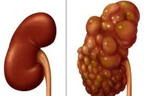 Mắc bệnh bẩm sinh, bé trai chào đời với quả thận như chùm nho