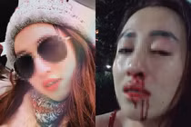 Vợ xinh bị chồng đánh gãy mũi ở TP HCM: nên “oánh” trả... còn không, ly hôn?