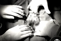 Phẫu thuật thành công u quái to gấp 5 lần quả thận bình thường