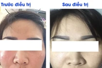 Trị nám ở spa, cô gái đau đớn mang ổ viêm trên mặt