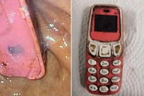 Suýt mất mạng vì nuốt chửng điện thoại di động vào bụng 