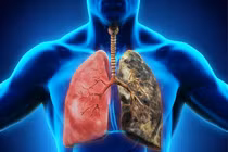 Những dấu hiệu trên chân có thể “dự đoán” ung thư phổi