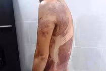 Nhắc hàng xóm đỗ xe ô tô, người phụ nữ bị hắt cả chảo dầu sôi vào người