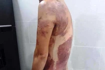 Nhắc hàng xóm đỗ xe ô tô, người phụ nữ bị hắt cả chảo dầu sôi vào người