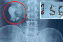 Video: Quý ông chứa 156 viên sỏi thận