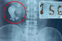 Video: Quý ông chứa 156 viên sỏi thận