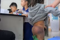 4 học sinh bị ông nội và 2 chị gái 10 tuổi đánh bầm tím khắp người vì nghịch nước