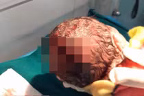 Con dâu sinh khó, mẹ chồng lấy dao rạch khiến cháu rách đầu