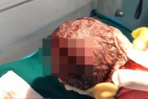 Con dâu sinh khó, mẹ chồng lấy dao rạch khiến cháu rách đầu