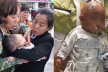 Bị táo rơi trúng đầu, bé gái 3 tháng tuổi chấn thương sọ não vĩnh viễn