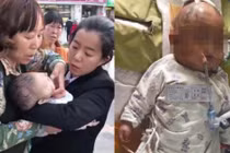 Bị táo rơi trúng đầu, bé gái 3 tháng tuổi chấn thương sọ não vĩnh viễn