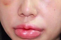 Tiêm filler làm đẹp ở Hà Nội, cô gái trẻ sưng tều môi, mắt 