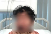 Bé gái bỗng "bỏng nặng" toàn thân sau khi uống thuốc tại phòng khám tư