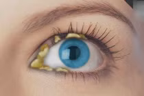 Mắt đầy ghèn vào buổi sáng: Dấu hiệu bệnh đừng coi thường