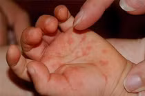 Bến Tre: Bé 2 tuổi tử vong do mắc bệnh tay chân miệng