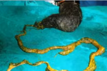 Hy hữu: Búi tóc dạ dày bé gái 6 tuổi dài hơn 1m, nặng gần 3kg trong