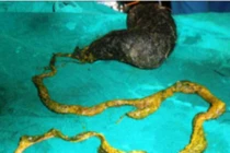 Hy hữu: Búi tóc dạ dày bé gái 6 tuổi dài hơn 1m, nặng gần 3kg trong