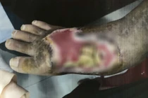 Kinh hoàng bàn chân của bé gái bị hoại tử do rắn độc cắn