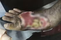 Kinh hoàng bàn chân của bé gái bị hoại tử do rắn độc cắn