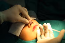 Tiêm filler nâng mũi, một phụ nữ ở TP HCM có thể múc bỏ mắt