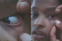 Chuyện lạ khó tin: Phát hiện một ổ kiến trong mắt bé gái 11 tuổi