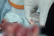 Đồng Tháp: Hoảng hốt bệnh nhân nhập viện với thùng lạnh đựng nhiều ngón tay