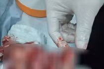 Đồng Tháp: Hoảng hốt bệnh nhân nhập viện với thùng lạnh đựng nhiều ngón tay