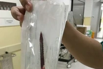 An Giang: Bé gái 4 tuổi vấp té bị bút bi đâm thấu ngực