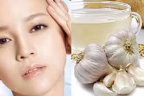 Cách trị mụn đầu đen siêu hiệu quả bằng tỏi