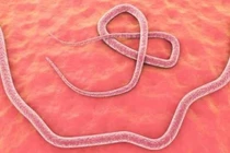 Hãi hùng 100 trứng sán dây trong não bé gái 8 tuổi