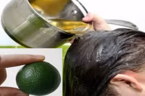 3 công thức làm sạch gàu nhanh chóng tại nhà