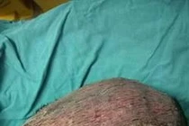 Thiếu nữ 17 tuổi bị hoại tử da đầu vì uốn tóc bằng hơi