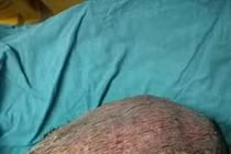 Thiếu nữ 17 tuổi bị hoại tử da đầu vì uốn tóc bằng hơi