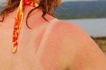 Cách nhanh nhất phục hồi làn da bị cháy nắng 