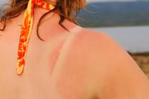 Cách nhanh nhất phục hồi làn da bị cháy nắng 