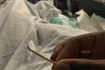 Que tránh thai "đi lạc" tới tim, kẹt trong động mạch phổi suốt 2 năm