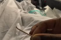 Que tránh thai "đi lạc" tới tim, kẹt trong động mạch phổi suốt 2 năm