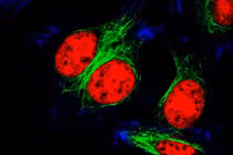 Tìm ra cách mới khống chế khối u ung thư buồng trứng