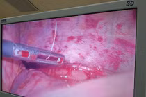 Đau tức ngực, bụng nửa tháng đi bệnh viện mới biết nguyên nhân