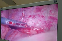 Đau tức ngực, bụng nửa tháng đi bệnh viện mới biết nguyên nhân