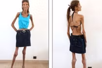 Mơ thành siêu mẫu, cô gái rơi vào bi kịch như bộ xương khô